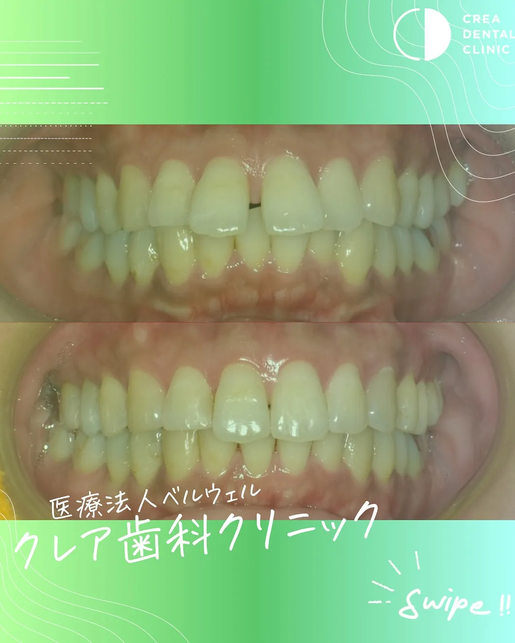 当院で行ったインビザラインの症例をご紹介👩‍🏫✨️