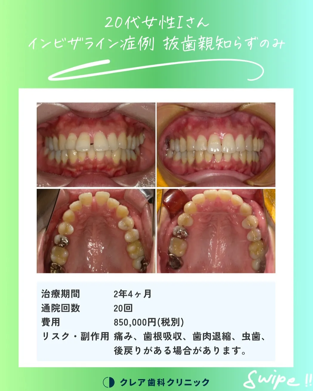 当院で行ったインビザラインの症例をご紹介👩‍🏫✨️