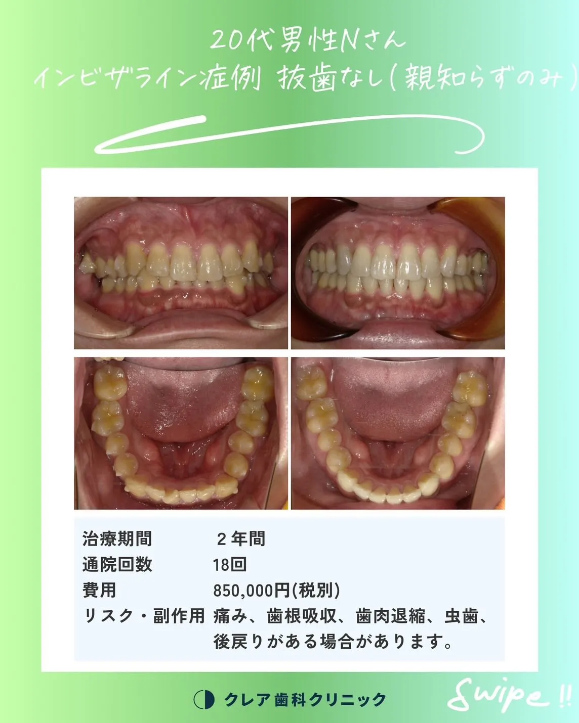 マウスピース矯正のご相談はクレア歯科で🦷